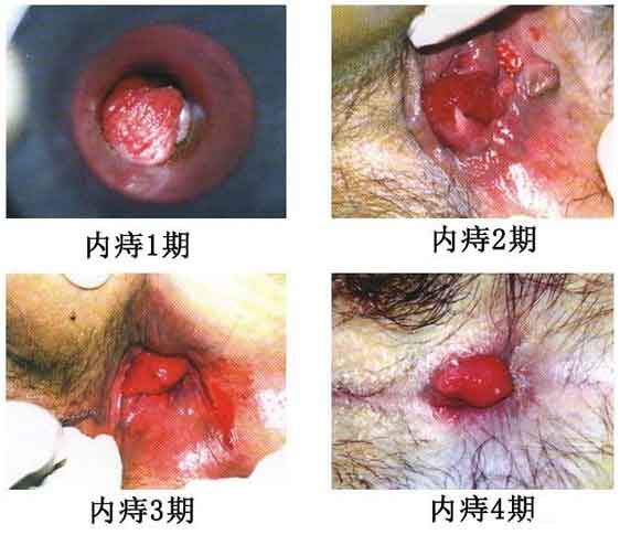 女性痔疮真人实拍图片：网上曝光的7个小偏方有效治痔疮