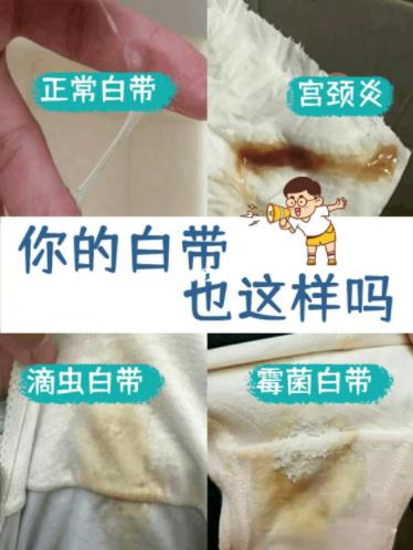 白带各种症状图片大全